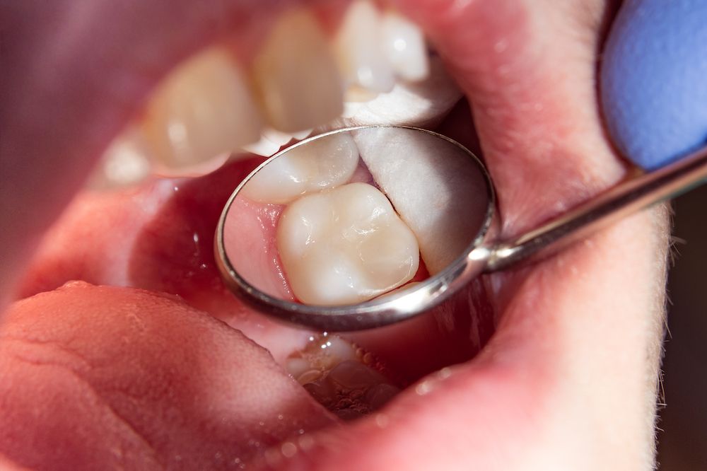 Are Composite Dental Fillings Better Than Metal?