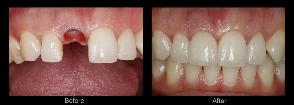 before and after results