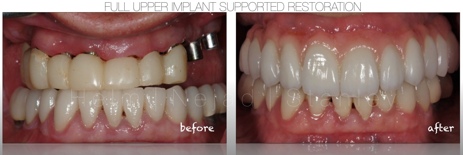 before and after results