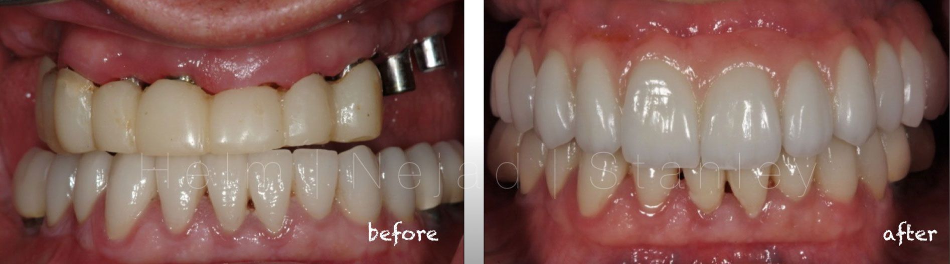 before and after results