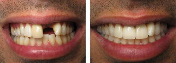 before and after results