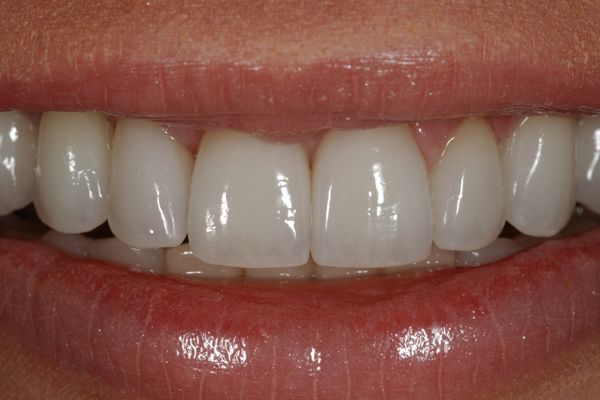before and after results