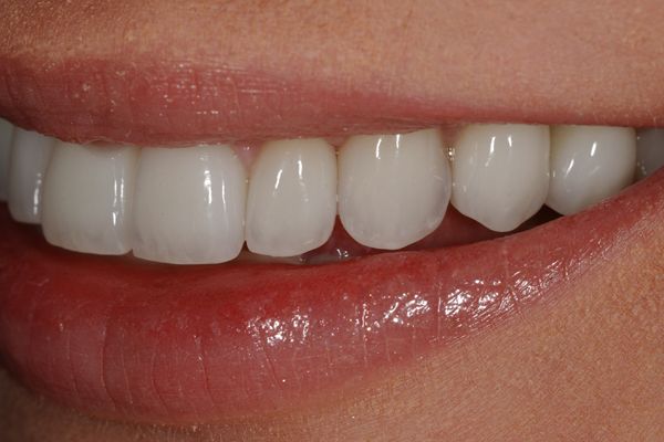 before and after results