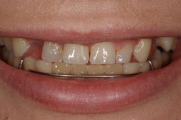 before and after results