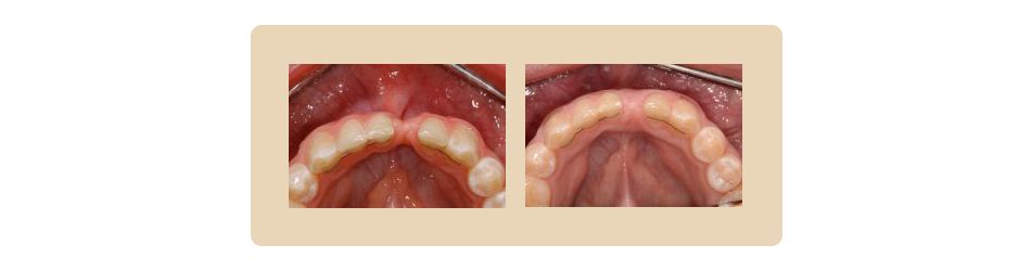 Bone grafting before and after result