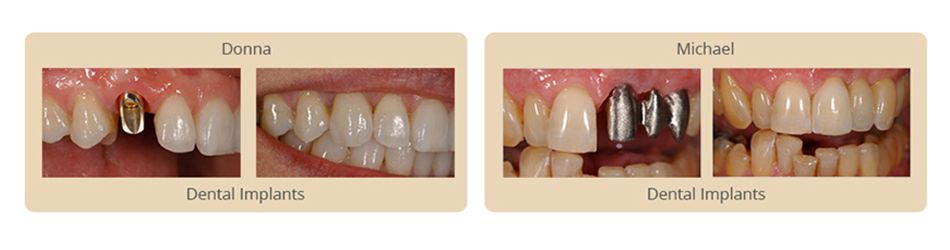 before and after results of dental implants