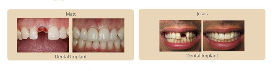 before and after results of dental implants
