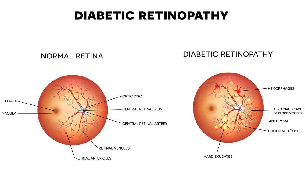 Are You Suffering From Diabetic Retinopathy?