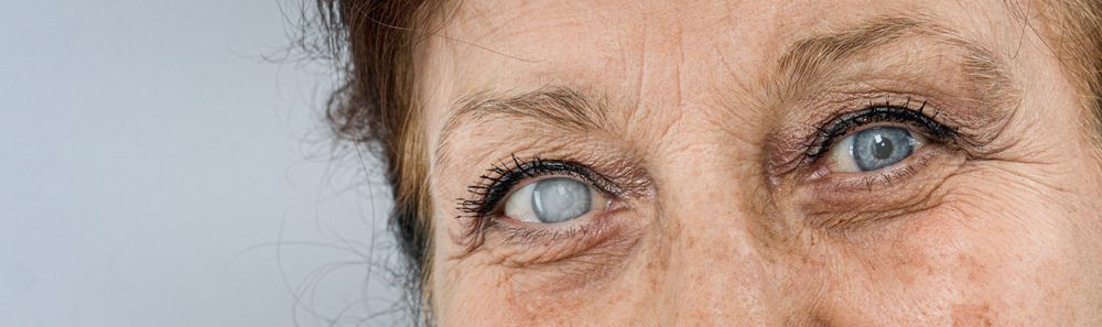 Cataract Causes: Understanding How Lens Clouding Starts