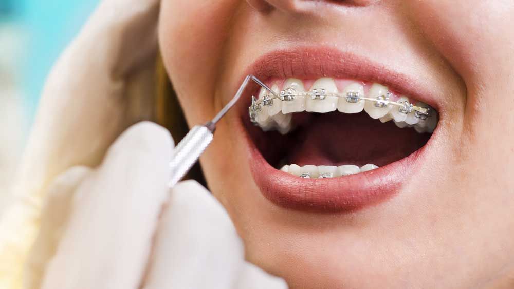 braces