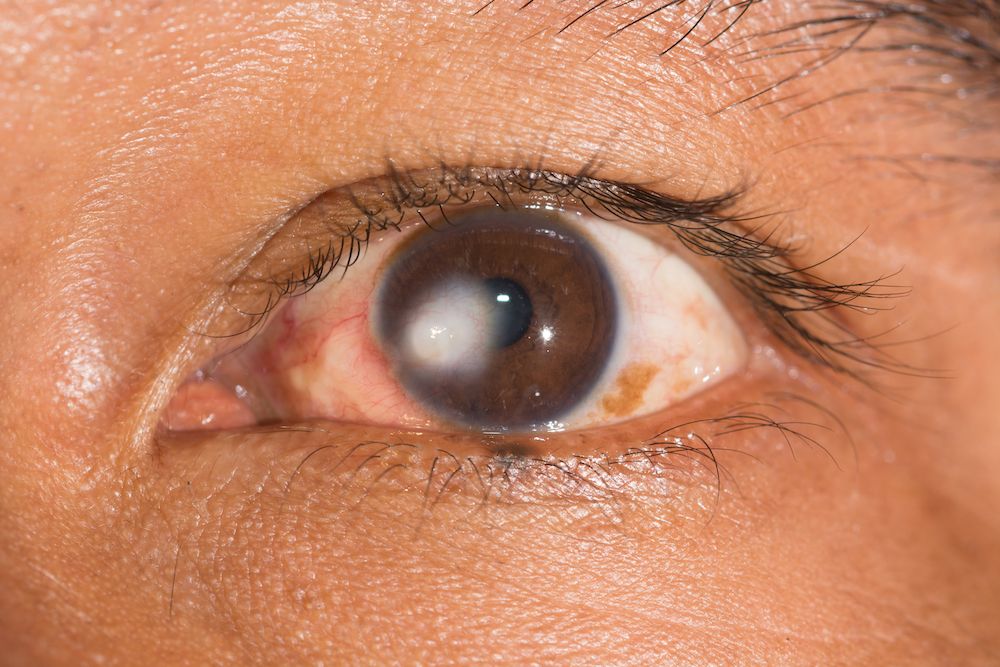 What Are Cataracts and How Are They Treated?