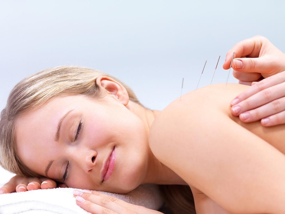 Acupuncture and Back Pain