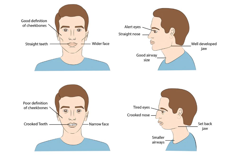 Dry mouth and mouth breathing