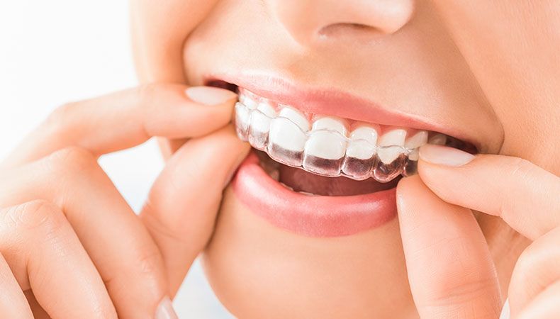 Invisalign Clear Braces New Westminster