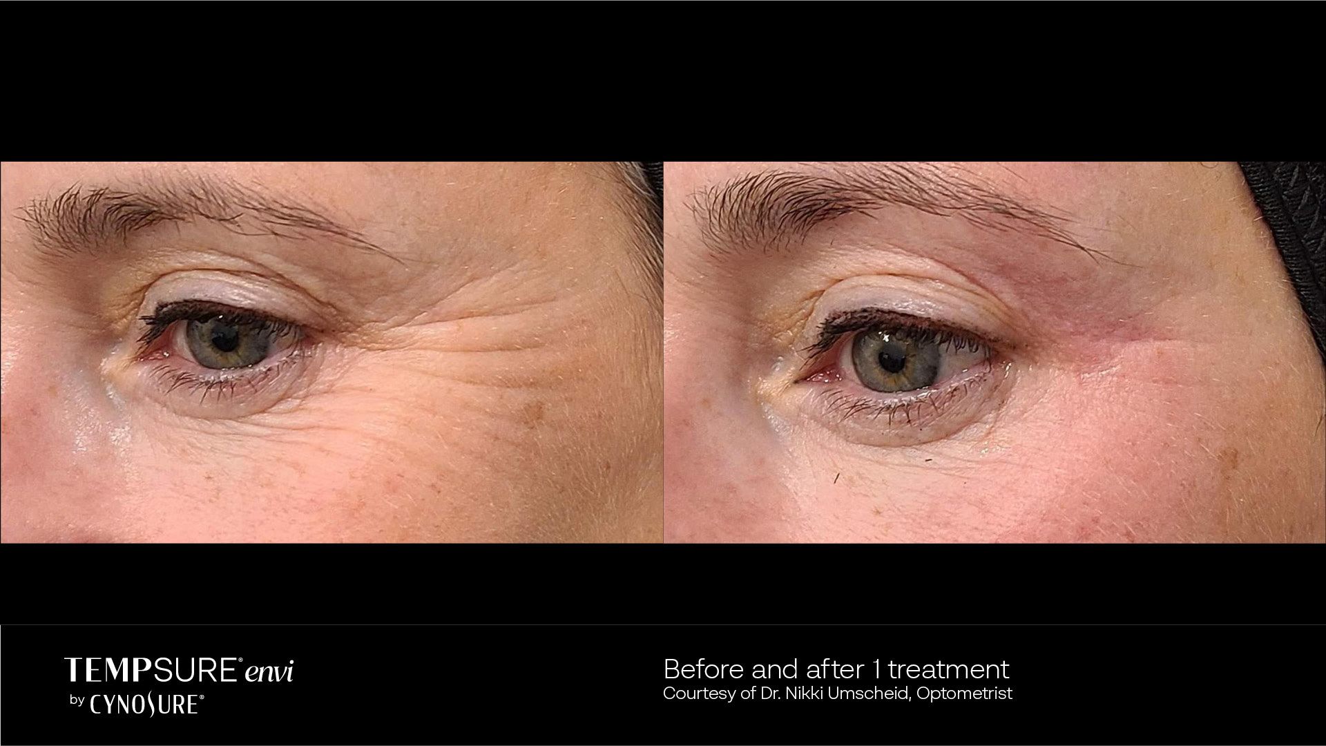 Before & after of Tempsure Envi treatment for dry eye at Positive Eye Ons in CA