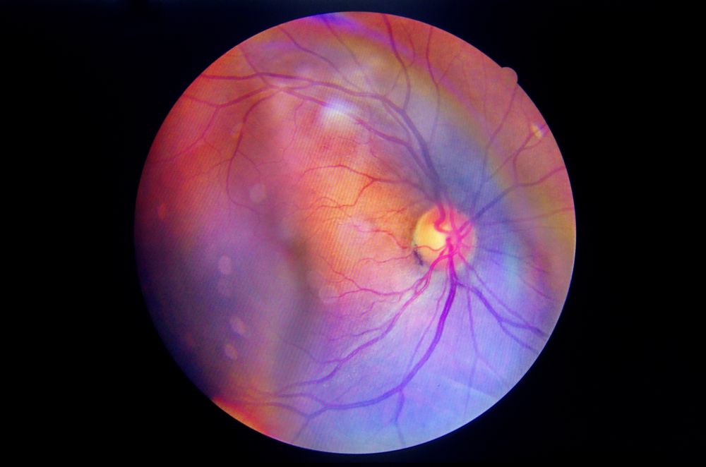 What Are the Early Warning Signs of Diabetic Retinopathy?
