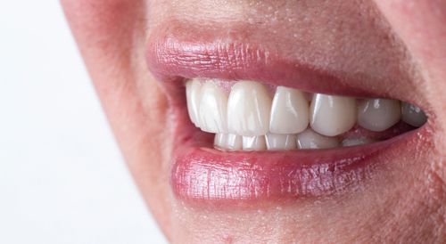 The Secret to a Confident Smile: How Crown Lengthening Can Transform Your Look