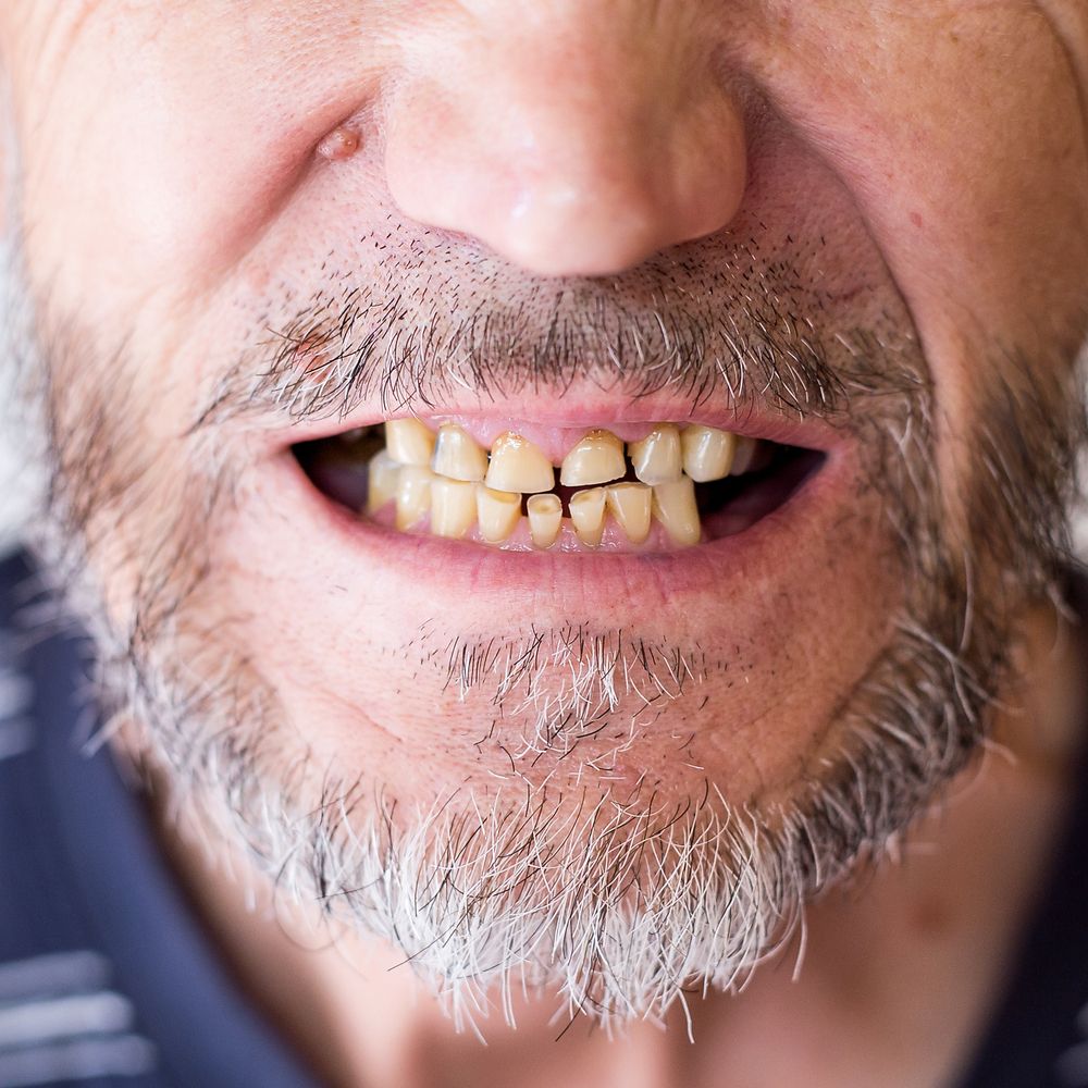 What Are the Early Warning Signs of Dental Disease?