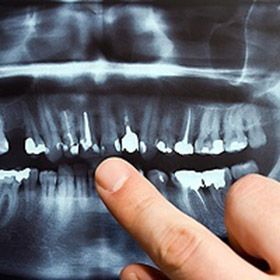 dental xrays