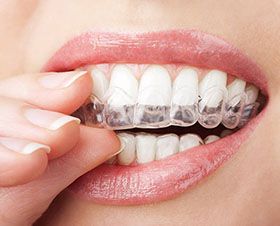 clear braces