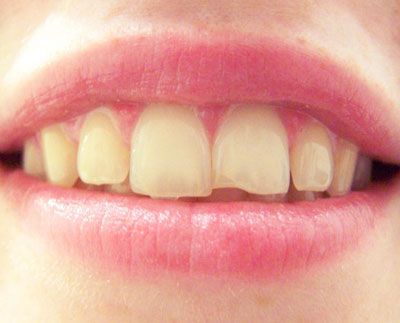 chipped tooth