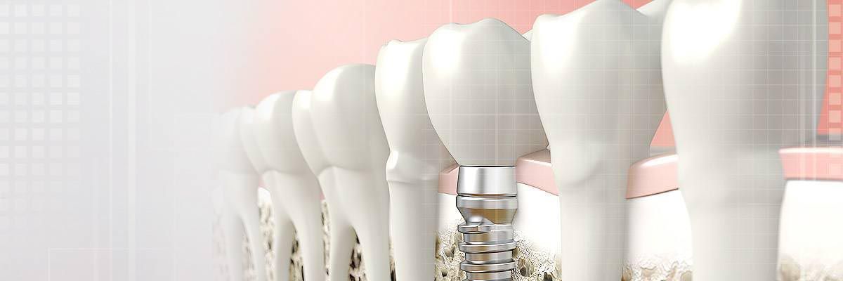 implants