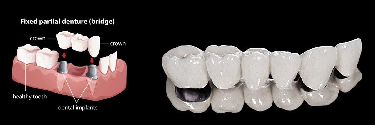 partial dentures