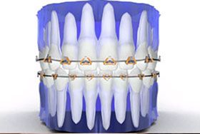 braces