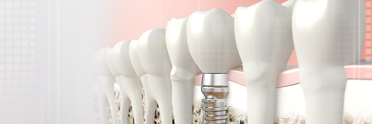 dental implants