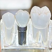 dental implant model