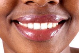 snap on smile