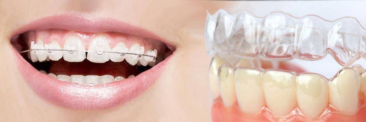 invisalign vs braces