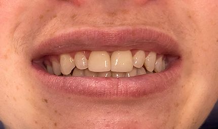 After Crowns Case 010