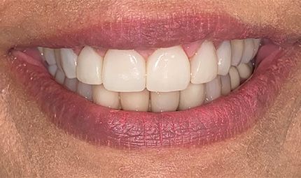 After Veneers Case 011