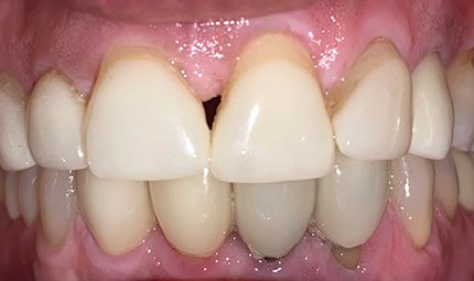 Before Veneers Case 011