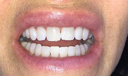 After Teeth Whitening Case 012
