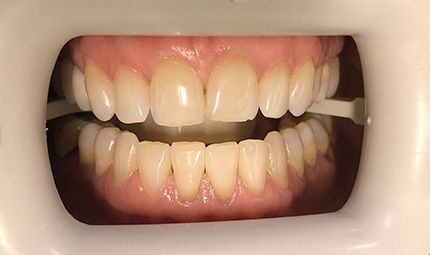 Before Teeth Whitening Case 012