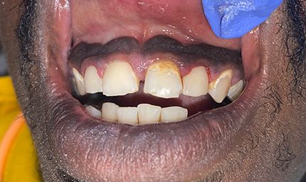 After Composite Bonding Case 013