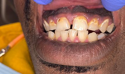 Before Composite Bonding Case 013