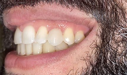 After Composite Bonding Case 001