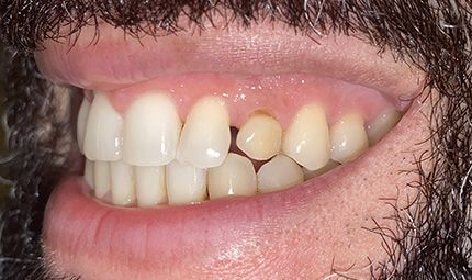 Before Composite Bonding Case 001