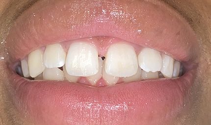After Composite Bonding Case 002