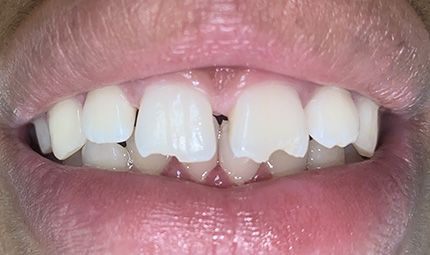 Before Composite Bonding Case 002