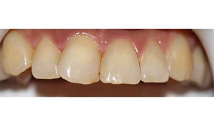 After Fillings Case 003