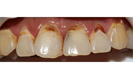 Before Fillings Case 003
