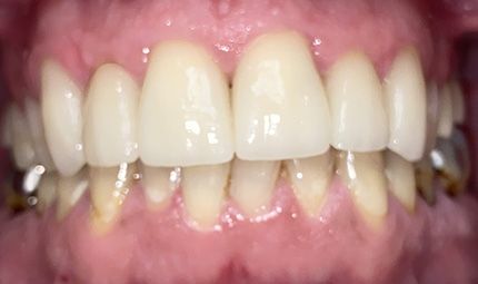 After Full Mouth Reconstruction Case 004