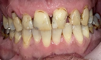 Before Full Mouth Reconstruction Case 004