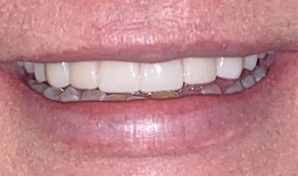 After Crowns Case 005