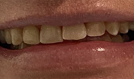 Before Crowns Case 005