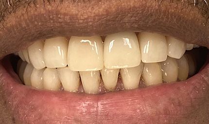 After Clear Aligner Therapy Case 006